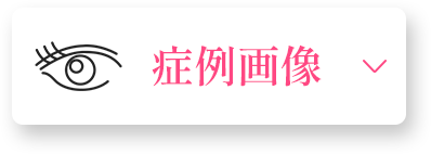 症例画像・クマ取り・クマとり・目元 クマ取り・クマとり 大阪・目の下 クマ取り・クマ 取り 名医・クマ 取り 裏 ハムラ・クマ 取り 大阪・クマ 整形 大阪・裏 ハムラ 法 名医 関西・ミルクリニック・ミルクリニック 大阪・ミルクリニック 心斎橋・ミルクリニック 裏ハムラ・ミルクリニック クマ取り