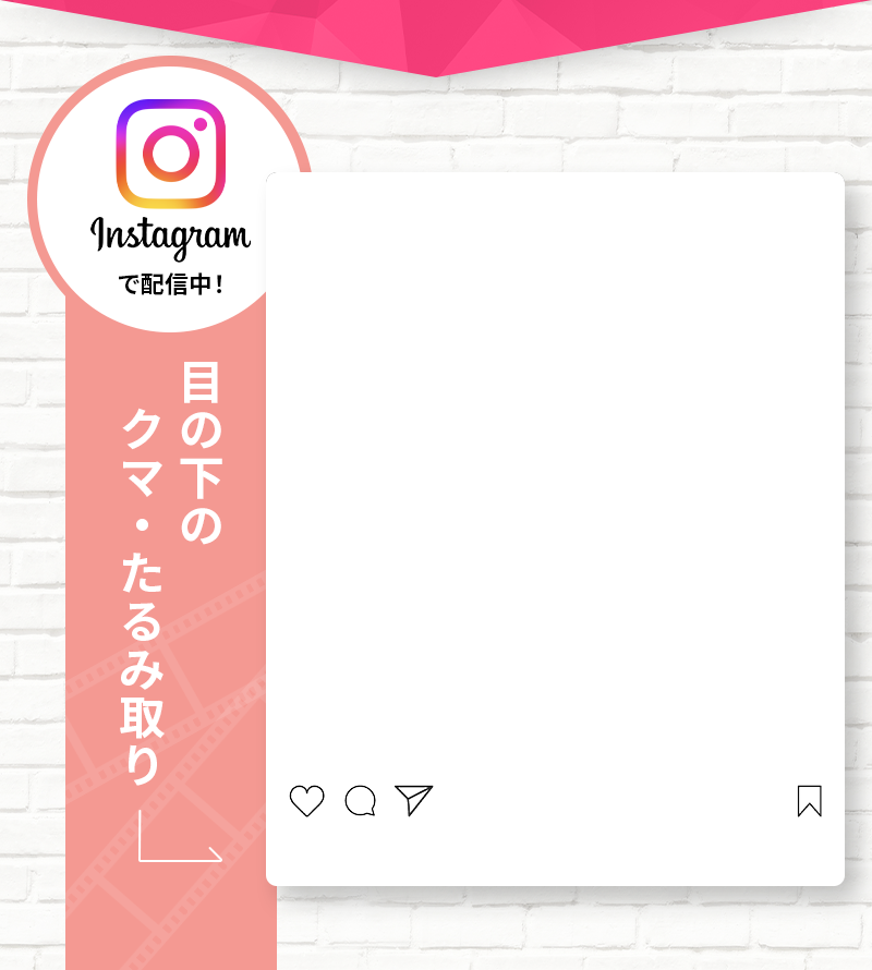 目の下のクマ・たるみの様子、Instagramで配信中！・クマ取り・クマとり・目元 クマ取り・クマとり 大阪・目の下 クマ取り・クマ 取り 名医・クマ 取り 裏 ハムラ・クマ 取り 大阪・クマ 整形 大阪・裏 ハムラ 法 名医 関西・ミルクリニック・ミルクリニック 大阪・ミルクリニック 心斎橋・ミルクリニック 裏ハムラ・ミルクリニック クマ取り
