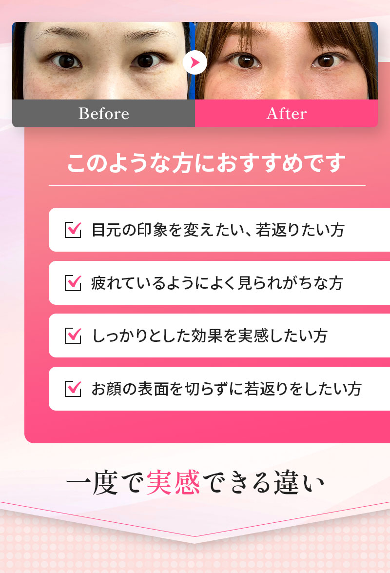このような方におすすめです ・目元の印象を変えたい、若返りたい方 ・疲れているようによく見られがちな方 ・しっかりとした効果を実感したい方 ・お顔の表面を切らずに若返りをしたい方 7日後時点で想定以上の腫れや内出血がある場合、最大20,000円分ポイントバック 追加料金なし 再施術保証制度 クマとり後の小じわ対策付き 一度で実感できる違い・クマ取り・クマとり・目元 クマ取り・クマとり 大阪・目の下 クマ取り・クマ 取り 名医・クマ 取り 裏 ハムラ・クマ 取り 大阪・クマ 整形 大阪・裏 ハムラ 法 名医 関西・ミルクリニック・ミルクリニック 大阪・ミルクリニック 心斎橋・ミルクリニック 裏ハムラ・ミルクリニック クマ取り