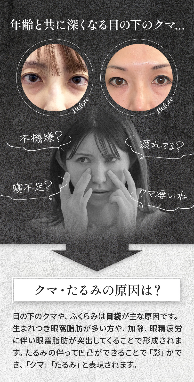年齢と共に深くなる目の下のクマ…「不機嫌？寝不足？疲れてる？クマすごいね…」 クマ・たるみの原因は？ 目の下のクマや、ふくらみは目袋が主な原因です。生まれつき眼窩脂肪が多い方や、加齢、眼精疲労に伴い眼窩脂肪が突出してくることで形成されます。たるみの伴って凹凸ができることで「影」ができ、「クマ」「たるみ」と表現されます。