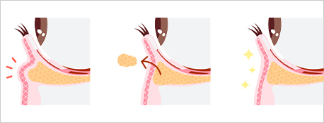 クマとりトリプルの施術解説