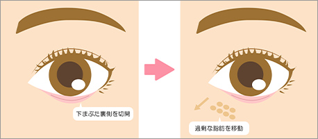 裏ハムラの施術解説